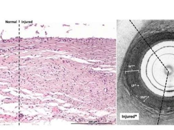 Urethral electrothermal injury shown through optical coherence tomography.
